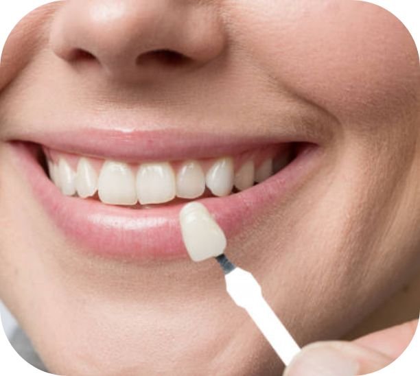 Dental Veneers