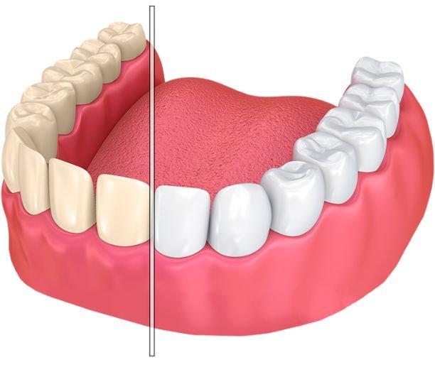 Teeth Whitening